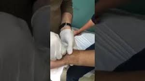 Kirilan Kol Tel Cikarma Kirschner Teli Youtube