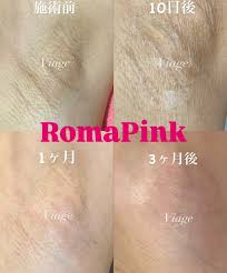 Viage💎八戸エステ八戸ローマピンク🩷八戸脱毛八戸メンズ脱毛八戸ハーブピーリング八戸VOS八戸リアボーテ (@viage525) •  Instagram photos and videos