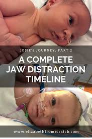 A Complete Timeline Of Jaw Distraction