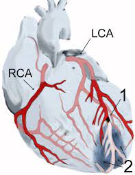 ¿cuáles son las causas más frecuentes del infarto de miocardio? Infarto Agudo De Miocardio Wikipedia La Enciclopedia Libre