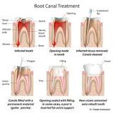 Image result for what is dental root canal treatment