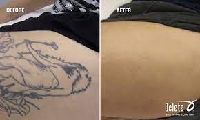 Judi is great and professional. Pin By Aleksandr Esaiashvili On Udalenie Tatu Laser Tattoo Removal Tattoos Tattoo Removal