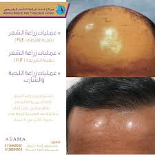 O Xrhsths مستشفى أدمة Sto Twitter مركز أدمة لزراعة الشعرالطبيعي زراعة الشعر بالشريحة زراعة الشعر بالإقتطاف زراعة الذقن زراعة الشارب إستشاريين أخصائيين طاقم طبي متكامل خبرة ١٩عاما رواد زراعة الشعر الرياض جدة Https T Co Bzlr2p7wv3