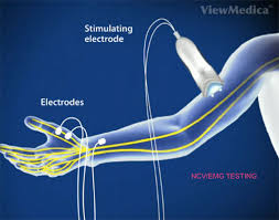 Cubital Tunnel Syndrome Exercises Treatment Dallas Hand Specialists