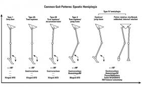 classification of gait patterns in cerebral palsy physiopedia