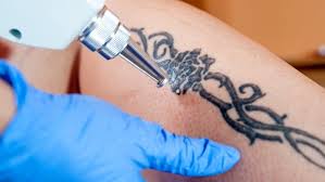 They use numbing cream which helps a bit but for me it feels like burning. Everything You Need To Know About Tattoo Removal