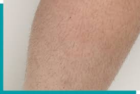 Hair removal service in flower mound. Laser Hair Removal Calgary Silverado Aesthetic Clinic