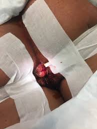 This is called a thrombosed hemorrhoid. Emergency Medicine News