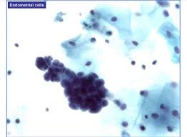 Atypical Endometrial Cell Of Undetermined Significant Atypical Cell