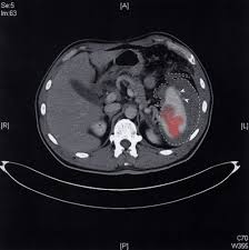 Know what is a ruptured spleen, what causes it, its diagnosis, symptoms, treatment and more. Splenic Rupture Amboss
