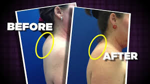 The most common cause of dowager's hump is poor posture, but you can also have been born with it (congenital kyphosis). New Procedure That Gets Rid Of The Buffalo Hump Abc13 Houston