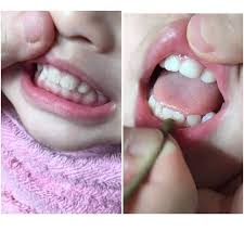 Ada yang memilihnya untuk villa atau tempat peristirahatan di perbukitan. Alternatif Hilangkan Tompok Putih Gigi Anak Gosokkan Kayu Sugi Di Rendam Air Suam Pa Ma