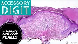 Image result for Supernumerary Digit