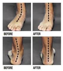 Flat Feet And Collapsed Arches Tampa Podiatrist Foot Exercises Arches Foot Exercises Flat Feet Exercises