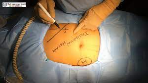 The mean number of needle punctures was 1.57 1.02 in the latif's point group and 2.9 1.5 in the palmer's point group (p ≤ 0.5). Laparoscopic Palmer S Access Technique