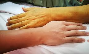 Cholangiocarcinoma What Are The About Signs Symptoms Of Bile Duct Cancer Medanta