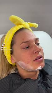 Lemon bottle fat dissolving 🍋 quick and insane results! Message to get  booked in