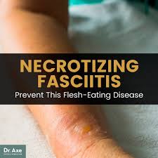 Necrotizing Fasciitis Avoid This Flesh Eating Disease Dr Axe Flesh Eating Bacteria Flesh Eating Centers For Disease Control And Prevention