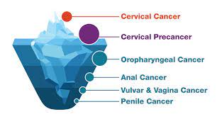 Having a risk factor does not mean that you will get cancer; Hpv Cancers Are Preventable Cdc