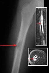 Loss of appetite and lethargy neurologic signs, such as a wobbly gait indications of severe pain Bone Tumor Types And Treatments Orthoinfo Aaos