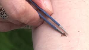 How To Properly Remove A Tick - Youtube