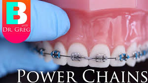 You can not get your braces off faster because you need braces if your teeth are not allinged well. Braces Faqs Frequently Asked Questions About Braces Orthodontics