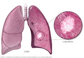 In most of the times, people who are affected with lung cancer may when the cancer cells blocks or narrow an airway, the breathing shortness problem can occur. Sparrow