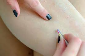 Sometimes, there is also pus inside the bump. Ingrown Hair On Legs Removal And Prevention