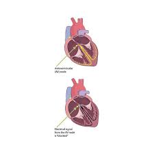Image result for Lyme Carditis