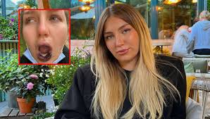 Sandra tok fillers i leppene