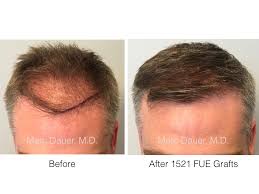 Saul lahijani employs a range of hair restoration techniques and offers his patients the most advanced each patient is different in their hair loss issues. Fue Hair Transplant Optimizing Your Donor And Making Every Graft Count Marc Dauer Md Hair Transplant Doctor Los Angeles