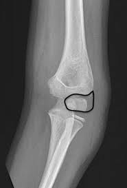 Image result for Lateral Condyle Fracture