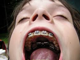Getting braces removed is an exciting thing, especially if a child wears them for two years, but how long does the process of removal take? The History Of Braces An Object Lesson The Atlantic