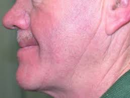 In some cases a rash appears on the cheek or in front of the ear. Sunscreen Allergy Dermnet Nz