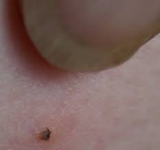 Just how dangerous are ticks, asks vanessa barford. About Ticks Lyme Disease Action