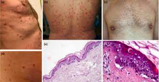 This is video manifestaciones cutáneas covid19 by joaquin morales on vimeo, the home for high quality videos and the people who love them. Manifestacoes Cutaneas Associadas A Covid 19 Uma Analise Critica Dos Dados Pebmed