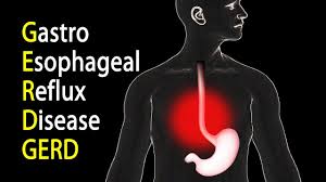 Gastrik atau istilah perubatannya, gastritis, adalah sejenis penyakit keradangan pada dinding/pengalas/mukosa perut yang mempunyai rawatan yang efektif. Gastrik Gerd Dan Anxiety Adaa Inspiration