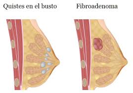 Que Son Los Bultos En Los Senos Y Signos De Alarma