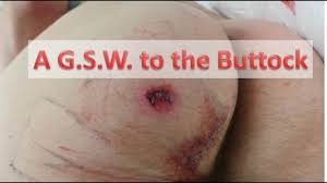 Rio asks in a definite attempt to distract her from the searing pain of the bullet graze on her side. A Gunshot Wound To The Buttock Youtube