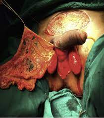 Save a life by knowing the signs and the most effective interventions. Minimal Invasive Laparoscopic Harvest Of The Greater Omental Flap For Fournier S Gangrene Scrotal Reconstruction Journal Of Plastic Reconstructive Aesthetic Surgery