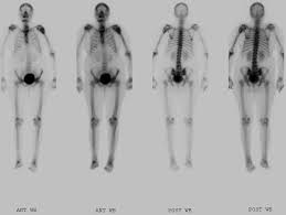 The uzi signs of thyroid cancer are conducted in order to detect this disease. Thyroid Cancer Metastasis Radiology Case Radiopaedia Org