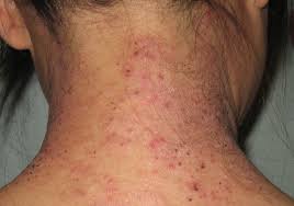 Image result for dermatitis contacta