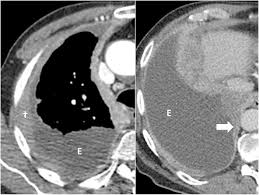 Almost always involve parietal … State Of The Art Radiological Investigation Of Pleural Disease Respiratory Medicine