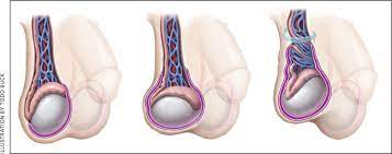 You may have had testicular torsion in the past or this could be your first experience with it. Testicular Torsion Diagnosis Evaluation And Management American Family Physician