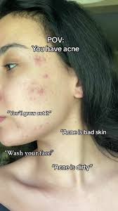 POV: you have acne. #foryou #acne #acnepositivity #fypシ