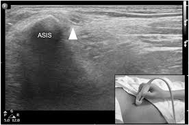 We did not find results for: Ultrasound Guided Lateral Femoral Cutaneous Nerve Conduction Study