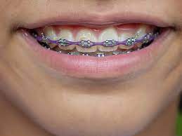 They might not be so natural the benefits of straight teeth. How Long Does It Take For Braces To Straighten Teeth Burlingame Smile Studio