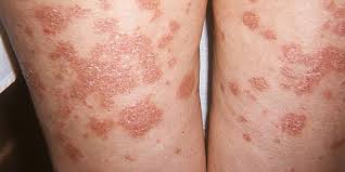 Tinea corporis poate rezulta prin contactul cu persoane infectate, animale sau obiecte. Pityriasis Versicolor La Om Simptome È™i Tratament Cu Medicamente È™i Remedii Populare