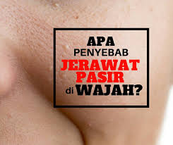 Metode yang digunakan sebagai cara menghilangkan jerawat pasir secara alami ini pun mudah sekali dipraktikkan. Meeracle Kl Perhatinan Tips Merawat Jerawat Pasir Facebook