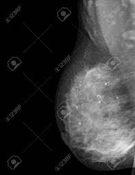 X Ray Of Breast Cancer Stock Photo Picture And Royalty Free Image Image 39100003